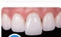 Crowns & Veneers