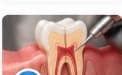 Root Canal Treatment